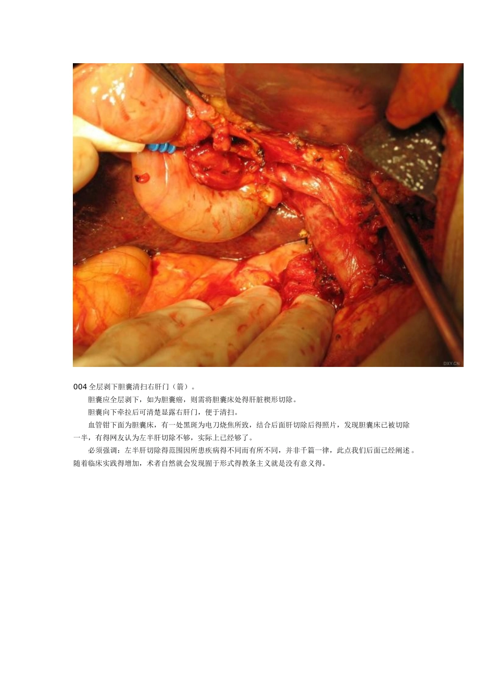 肝脏手术、肝门部胆管癌根治性切除术及胆囊癌根治术_第3页