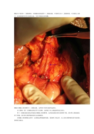 肝脏手术、肝门部胆管癌根治性切除术及胆囊癌根治术