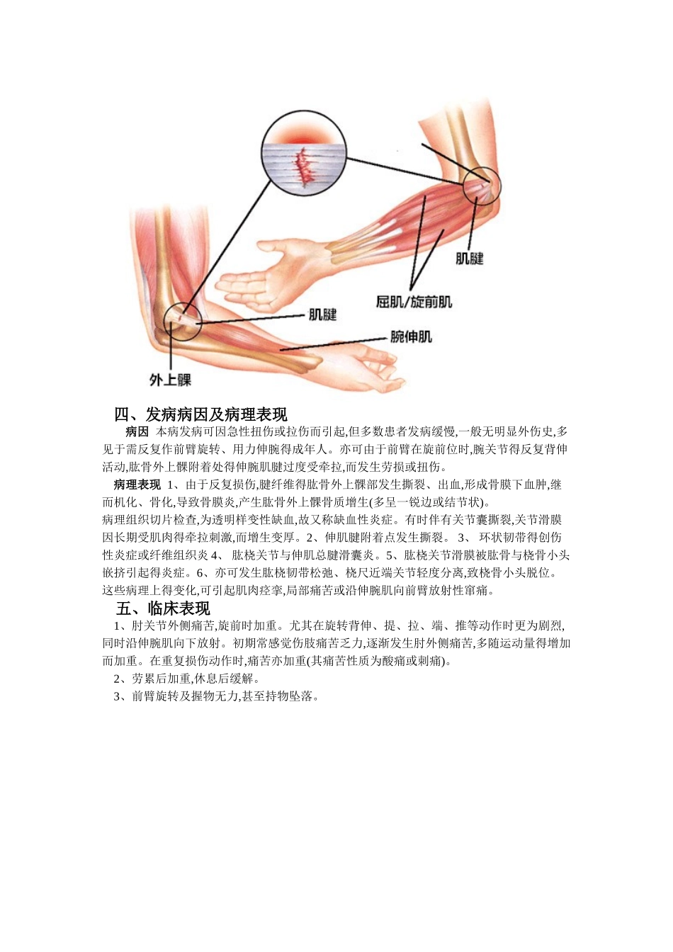 肱骨外上髁炎的封闭治疗_第2页