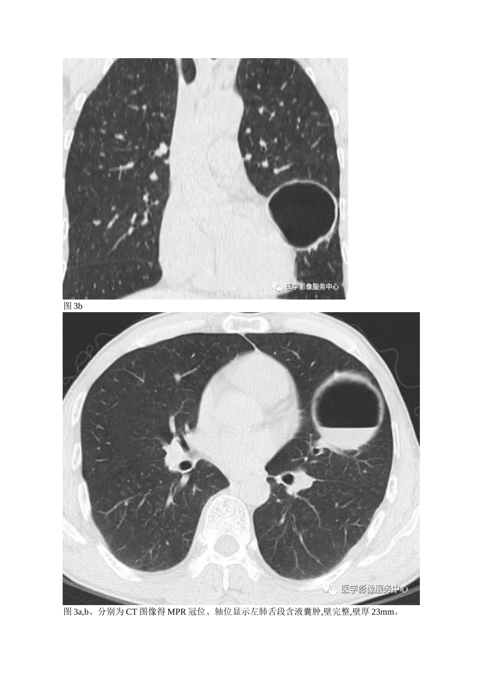 肺含气囊腔分类、定义及CT诊断_第3页