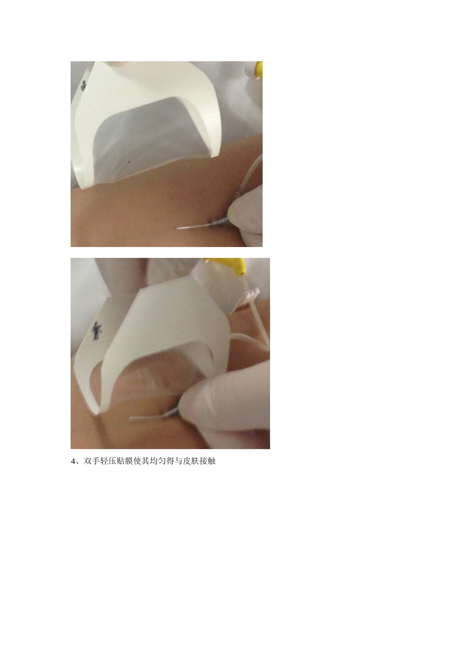 静脉留置针贴膜流程_第2页