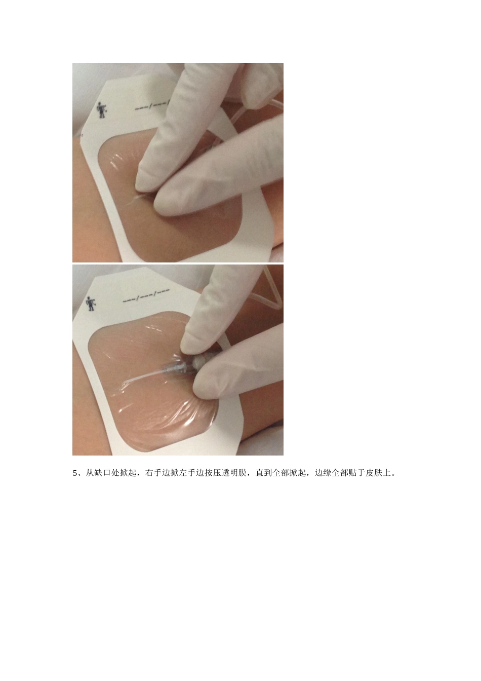 静脉留置针贴膜流程_第3页