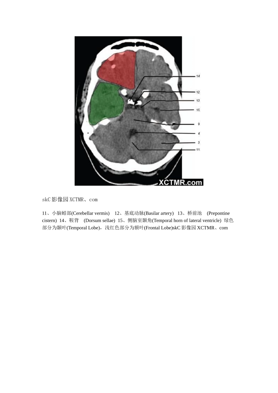 颅脑CT解剖带图解_第3页