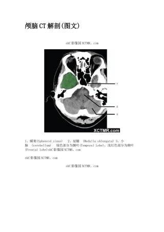 颅脑CT解剖带图解