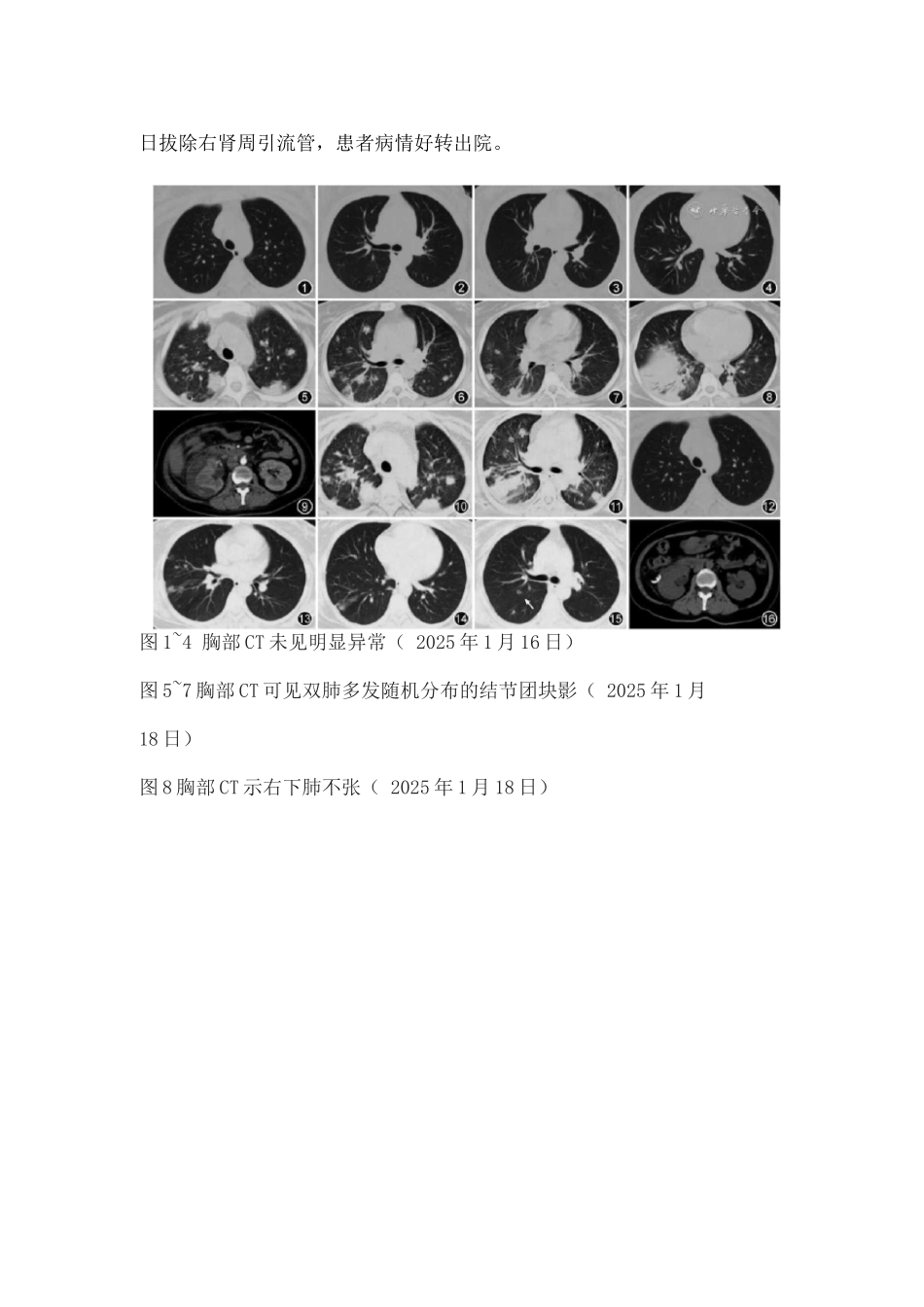 2025双肺多发结节团块影合并右侧肾周混杂密度影_第3页