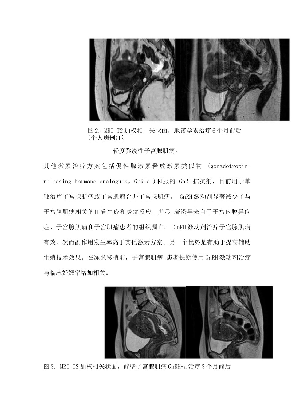 2025子宫腺肌病的非手术治疗_第3页