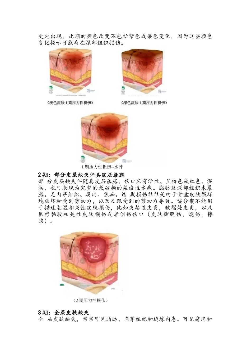 2025年压疮诊疗及护理规范_第3页