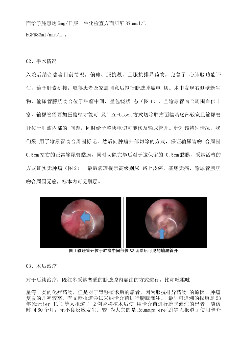 2025特殊类型的膀胱肿瘤处理肾移植术后输尿管膀胱吻合口周围膀胱肿瘤的初步处理经验_第2页