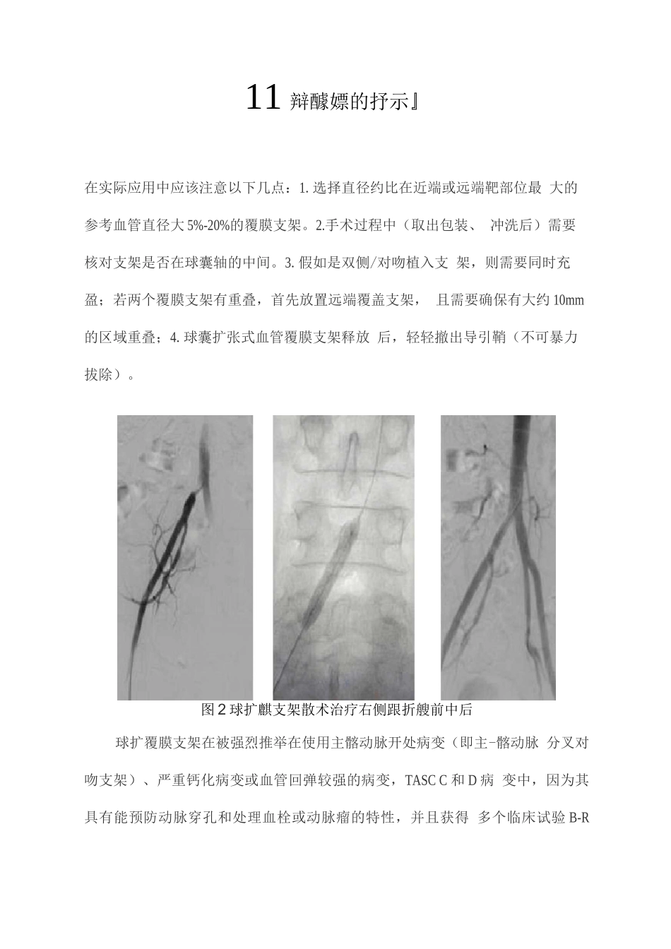2025球扩覆膜支架的应用体会_第2页