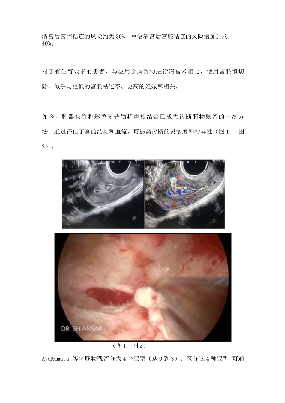 2025组织去除系统在胚物残留治疗中的作用_第2页