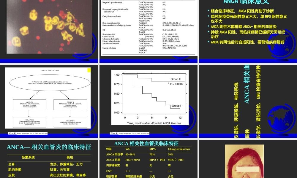 ANCA相关性血管炎71357