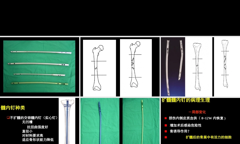 AO髓内钉固定技术-医学课件