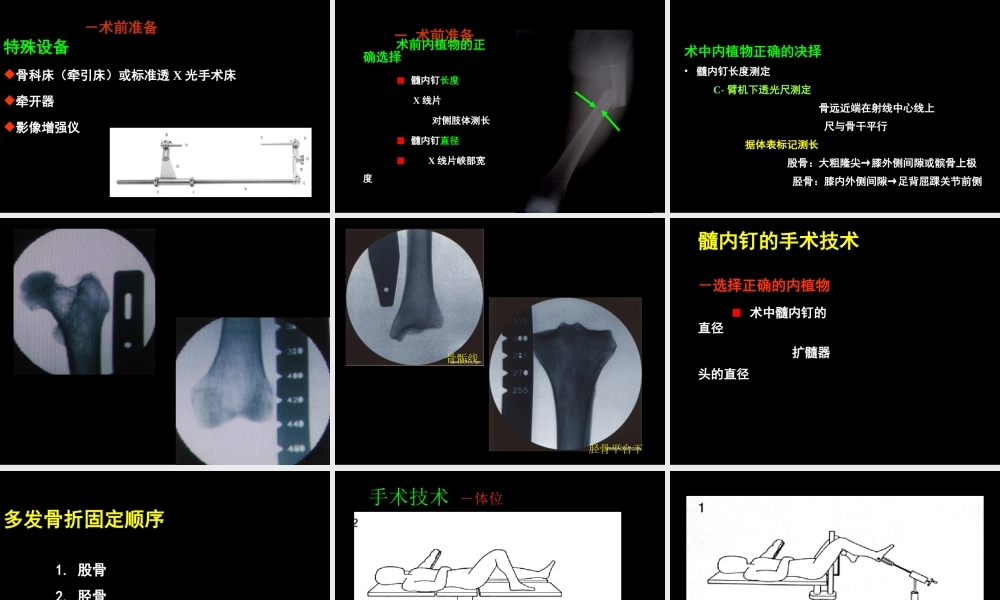 AO髓内钉固定技术-医学课件