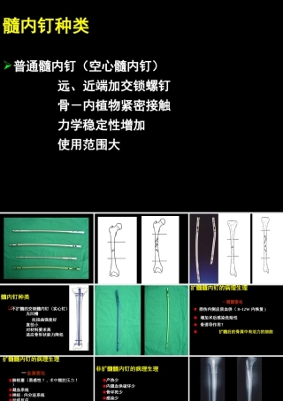 AO髓内钉固定技术-医学课件