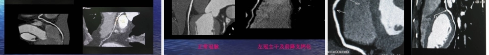 CT图像后处置技术专题培训课件