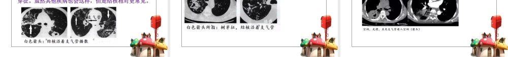 CT诊断肺结核PPT培训课件
