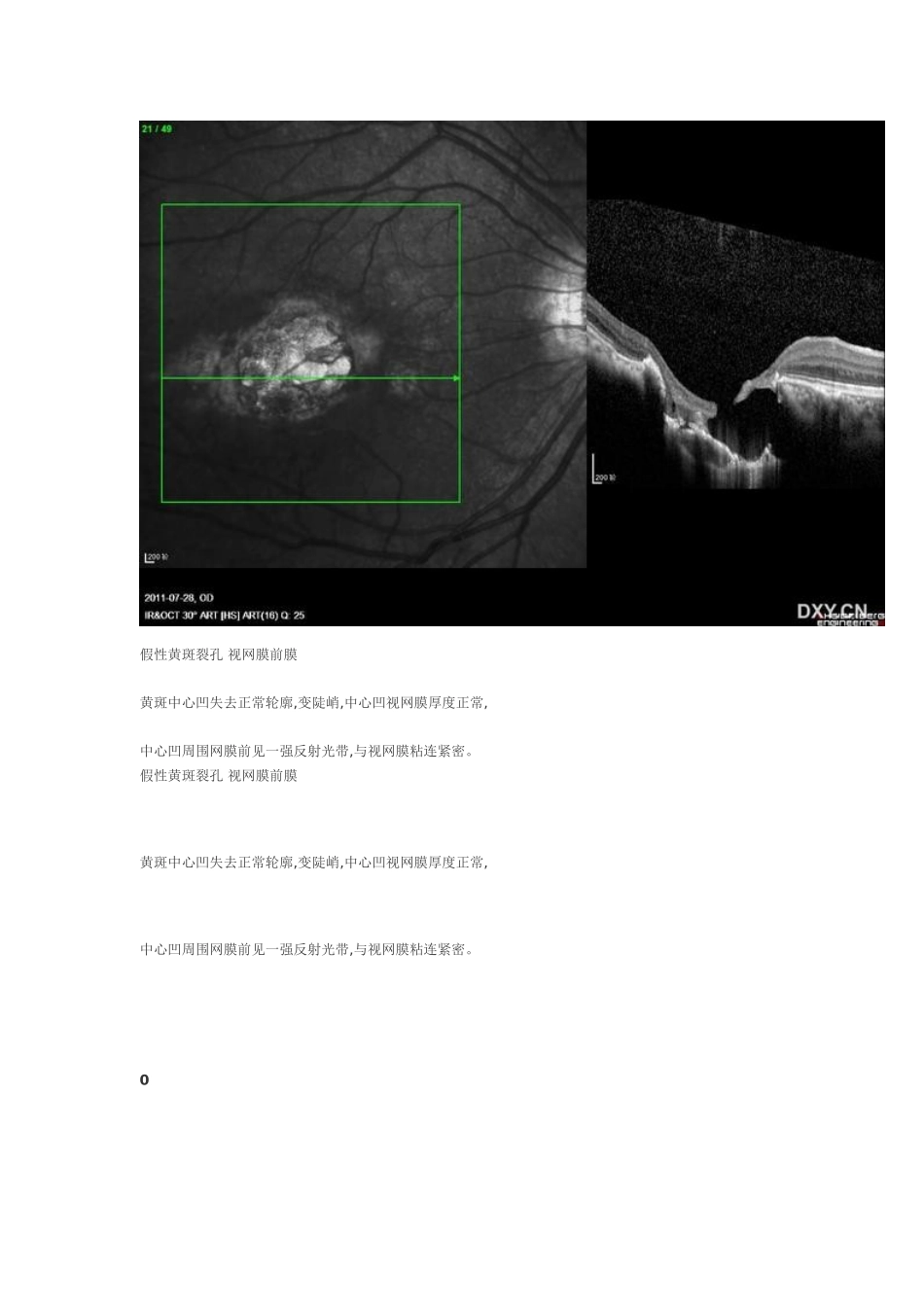 OCT视网膜10层结构_第3页