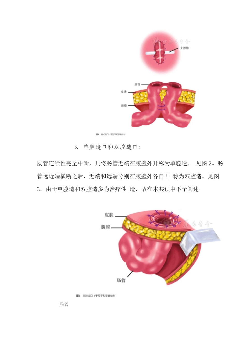 中低位直肠癌手术预防性肠造口中国专家共识3_第3页