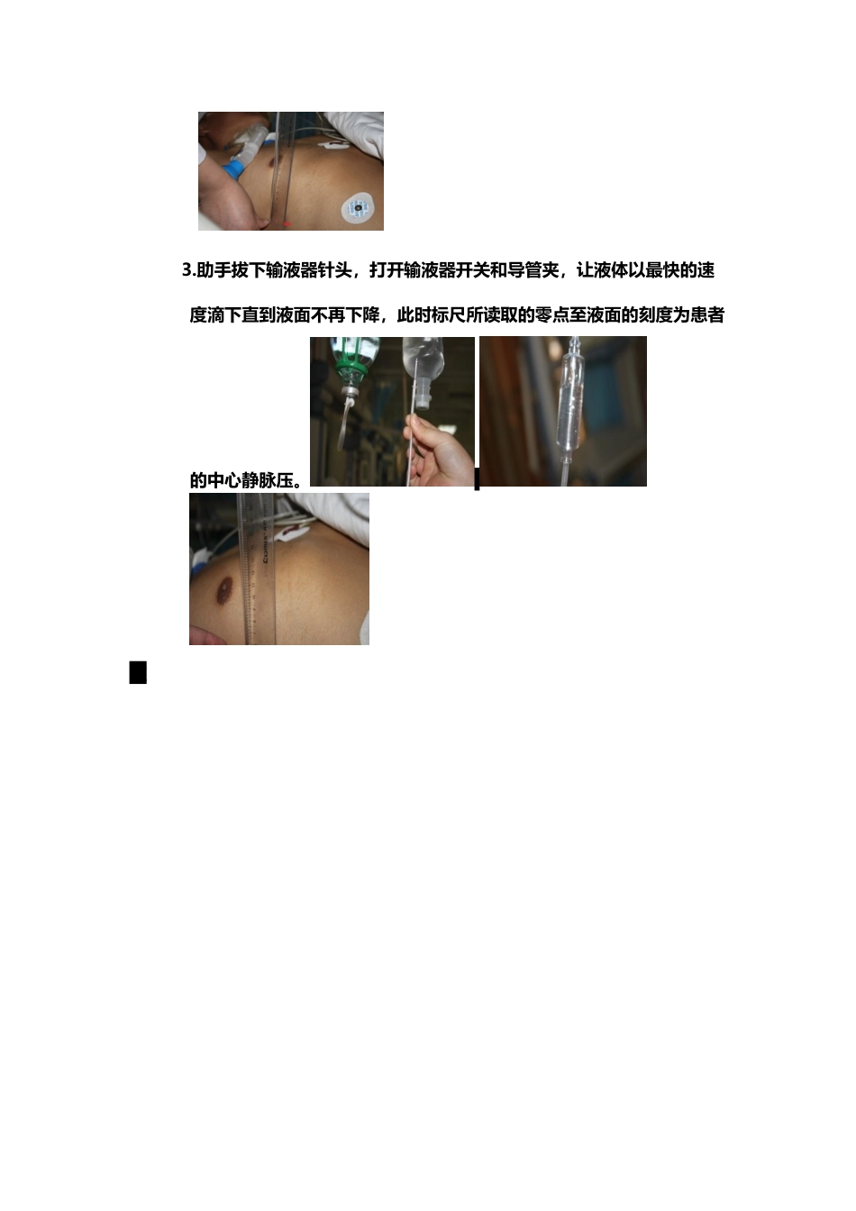中心静脉压标尺测量操作图_第3页