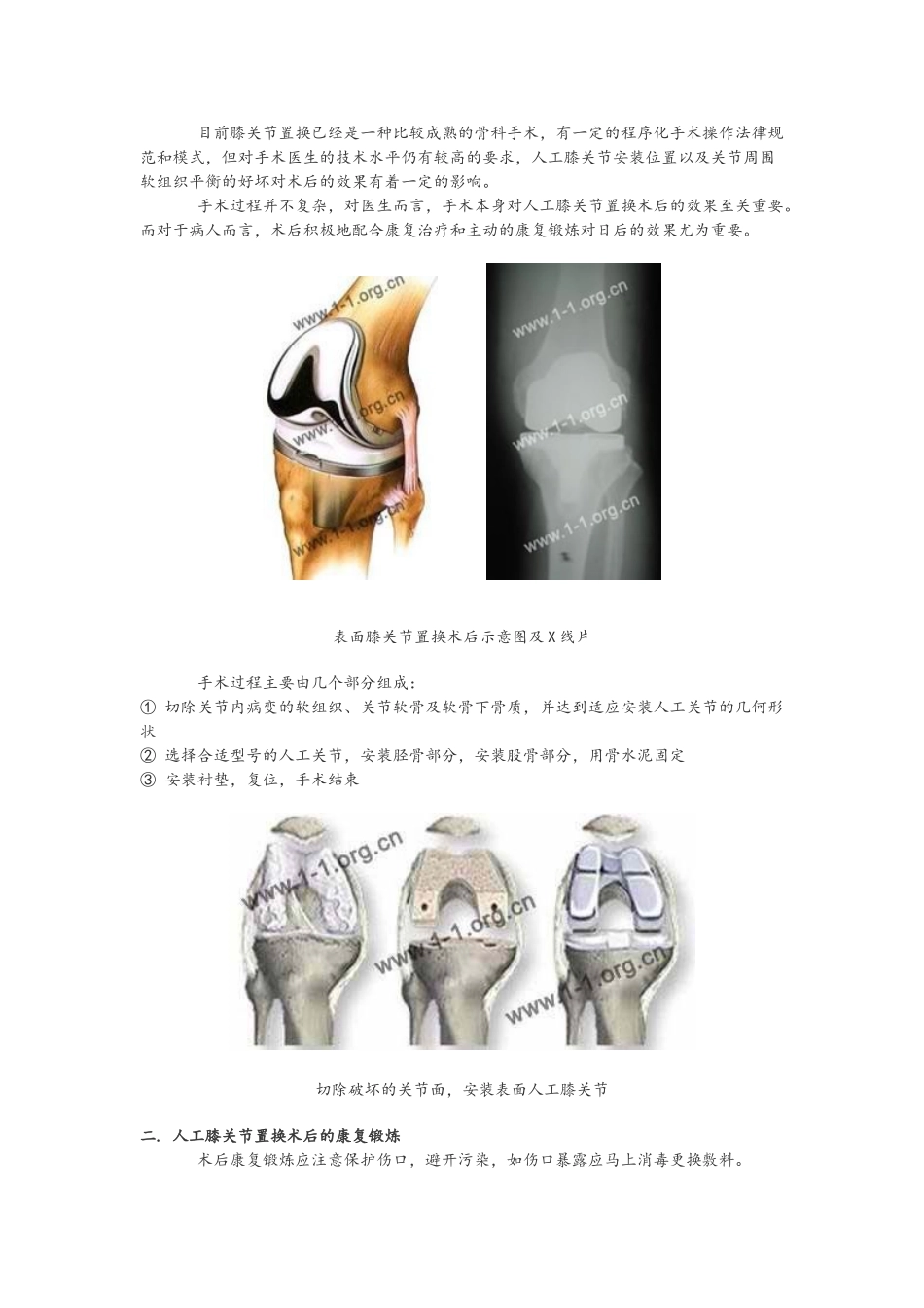 人工膝关节置换术后康复指南_第3页