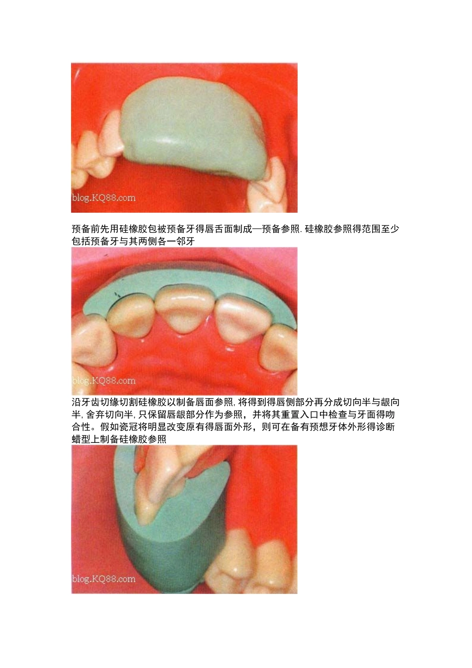 全瓷牙备牙方法图例_第2页