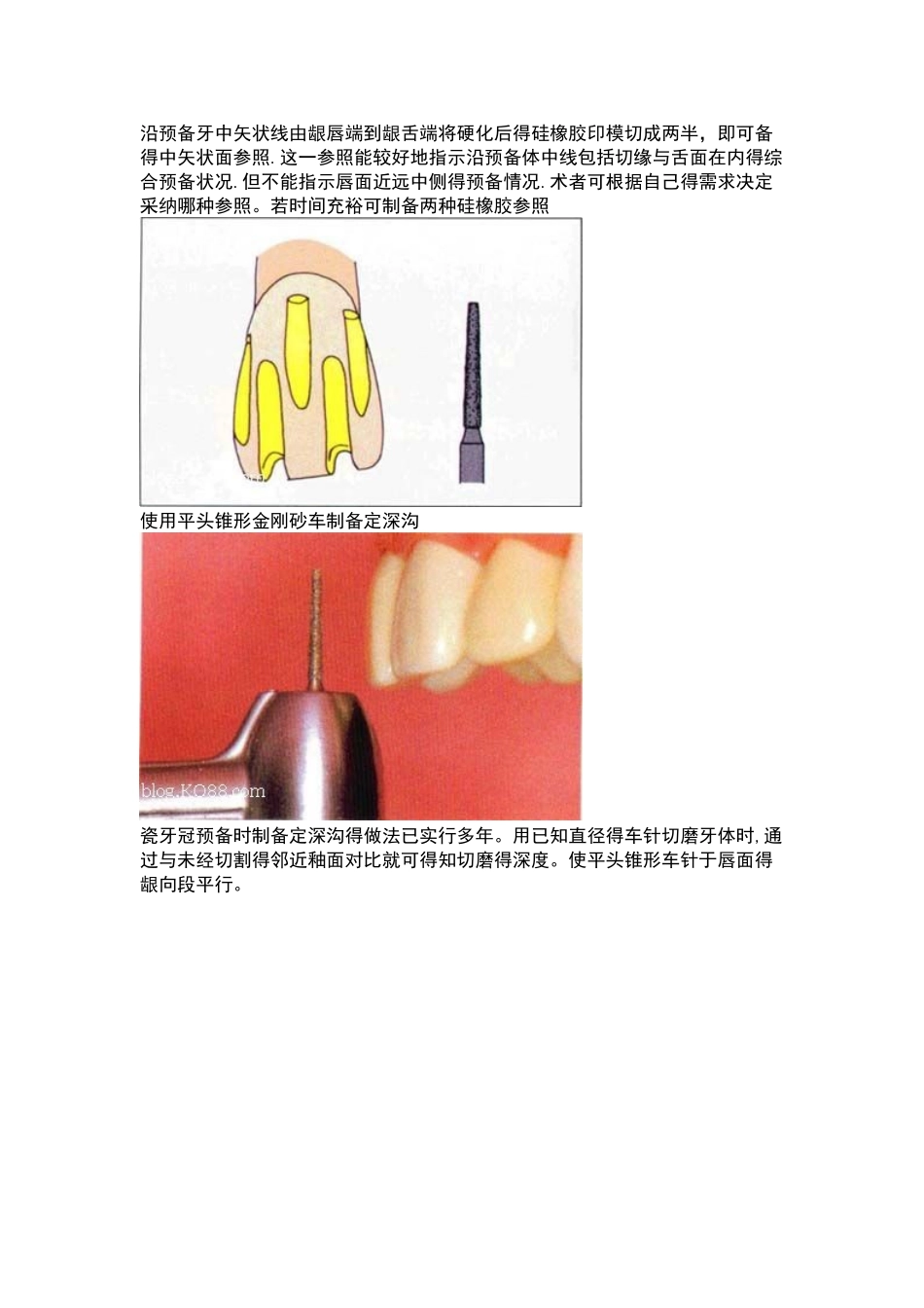 全瓷牙备牙方法图例_第3页