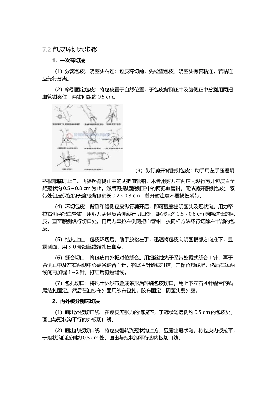包皮环切术步骤_第2页