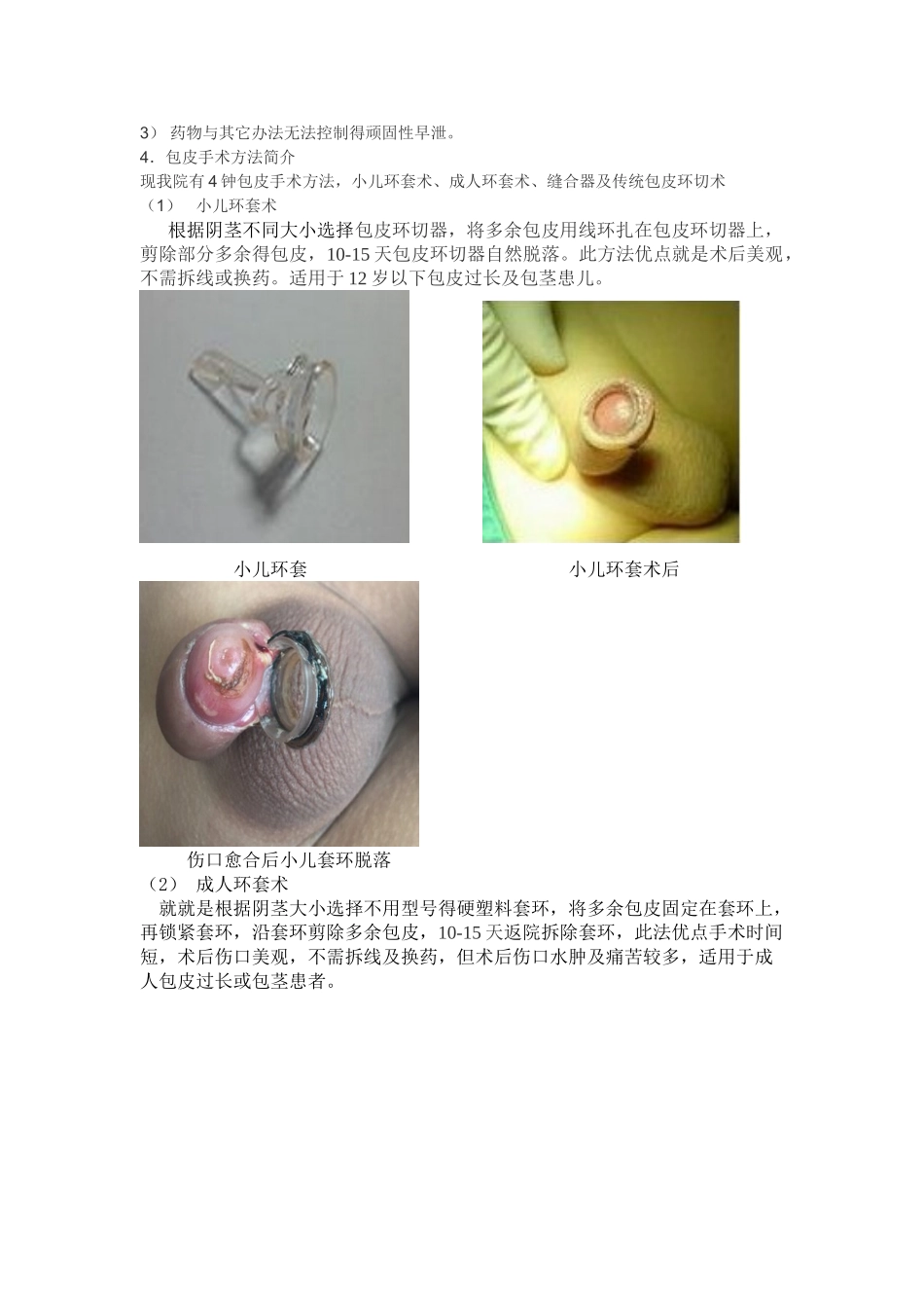 包皮过长及包茎_第2页