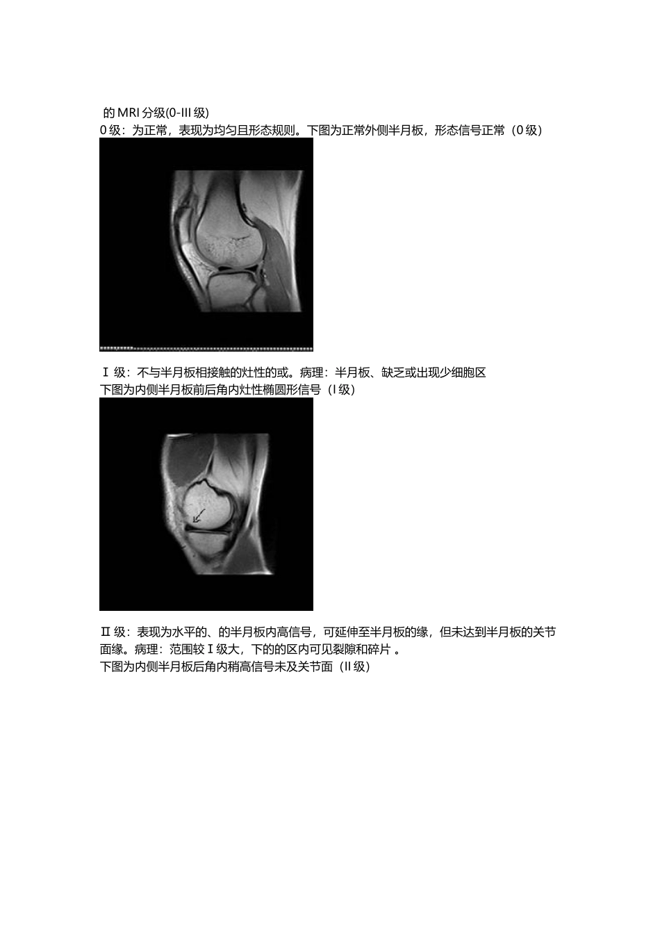 半月板损伤的MRI分级_第2页