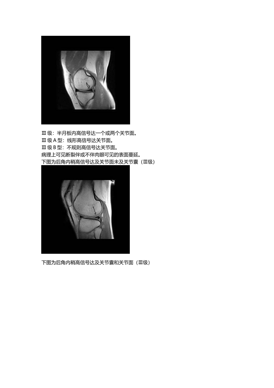 半月板损伤的MRI分级_第3页