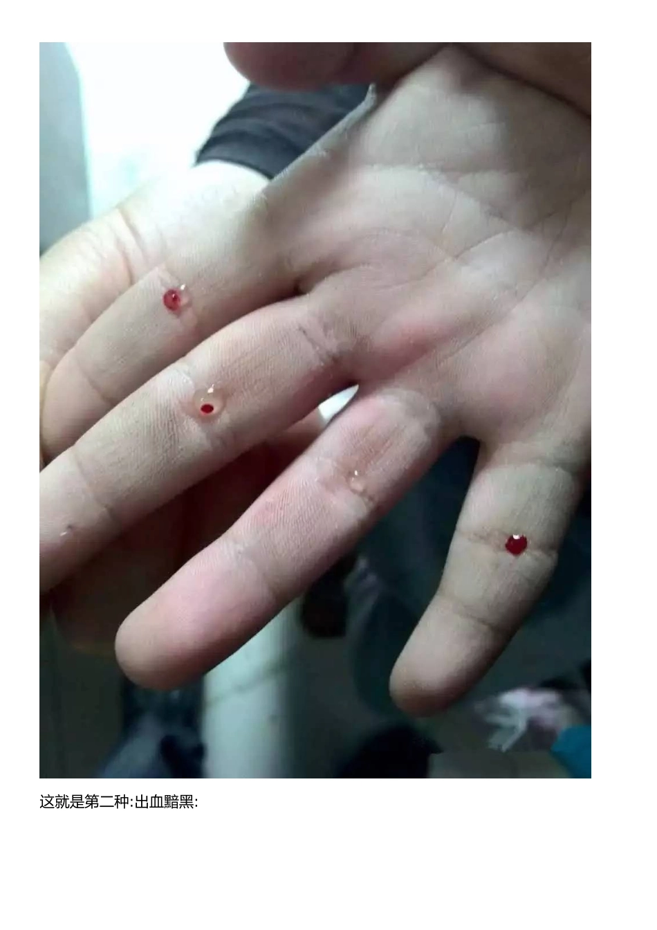 小儿挑食-食欲不振-运用放血疗法扎四缝_第3页