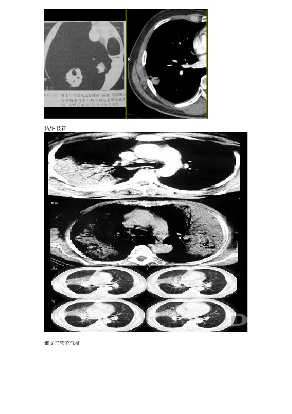 常见胸部CT征象_第2页