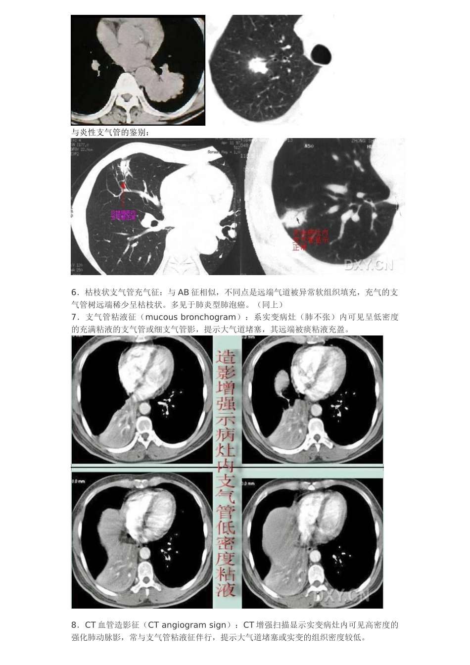 常见胸部CT征象_第3页