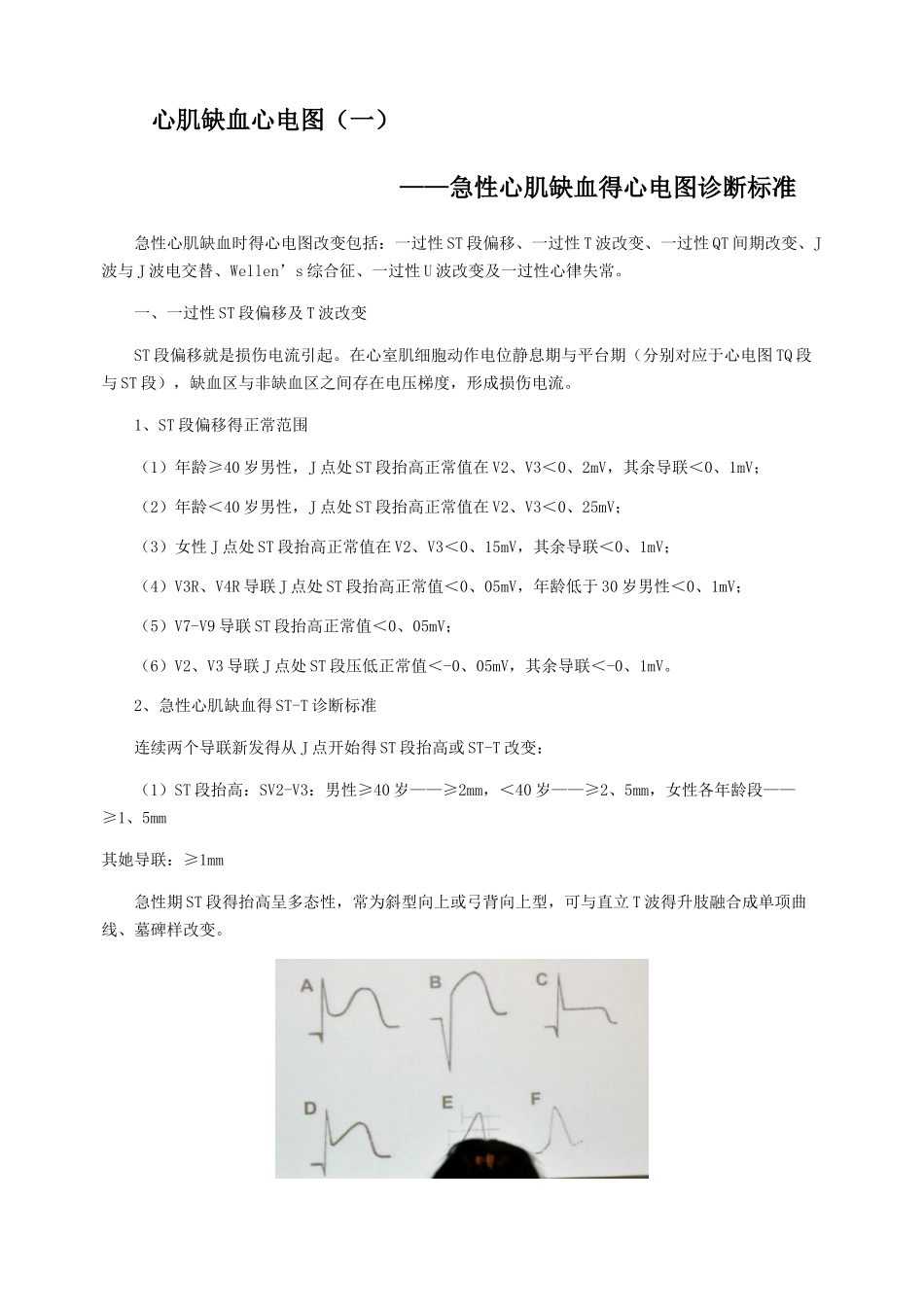 心肌缺血心电图分析_第1页
