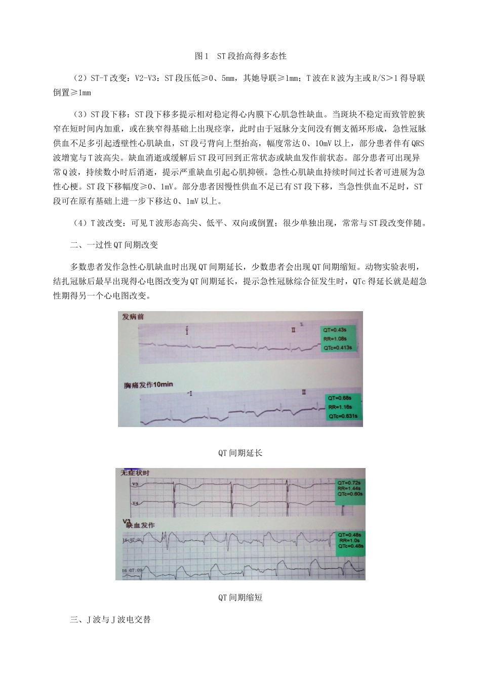 心肌缺血心电图分析_第2页