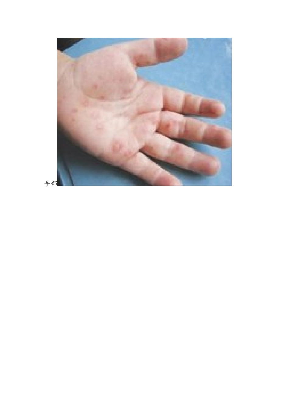 手足口病初期症状及图片_第2页