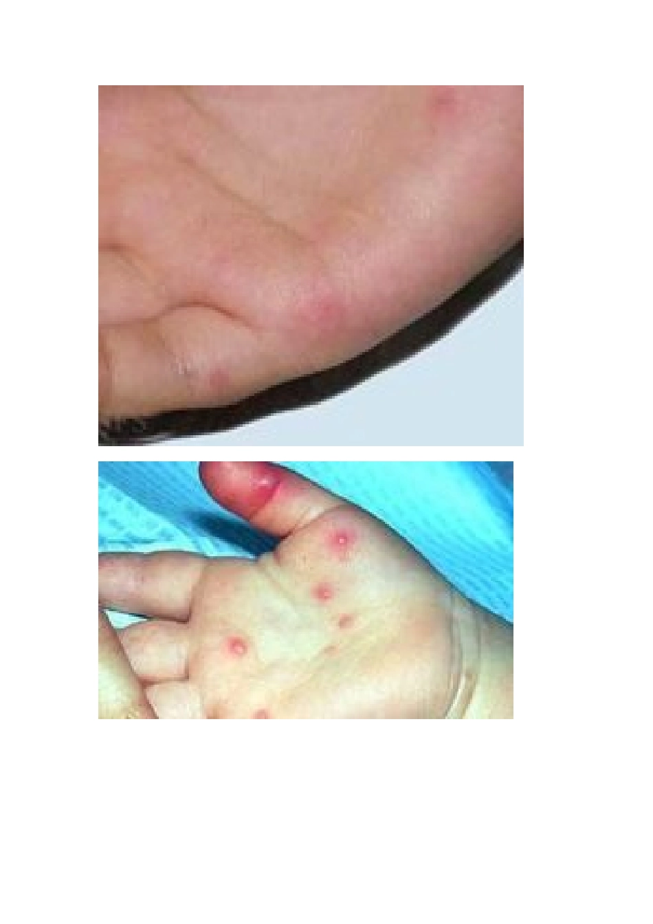 手足口病初期症状及图片_第3页