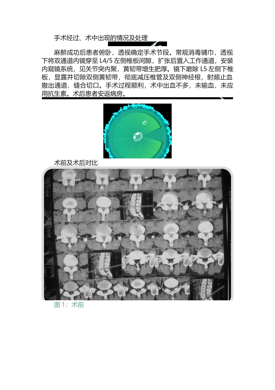 探索创新，齐鲁典范山东大学齐鲁医院刘新宇教授UBE椎管减压手术_第3页