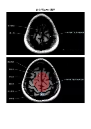 正常颅脑磁共振图示