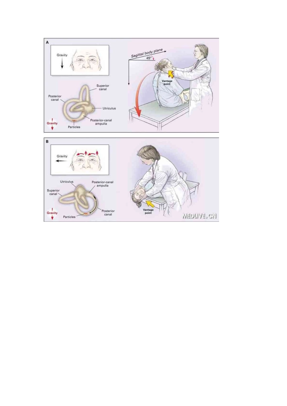耳石症检测实验及复位手法大全_第2页