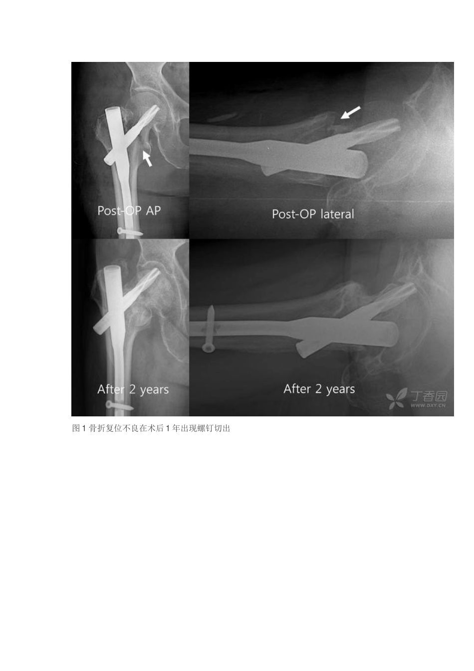股骨转子间骨折骨钩撬拨复位技术_第2页