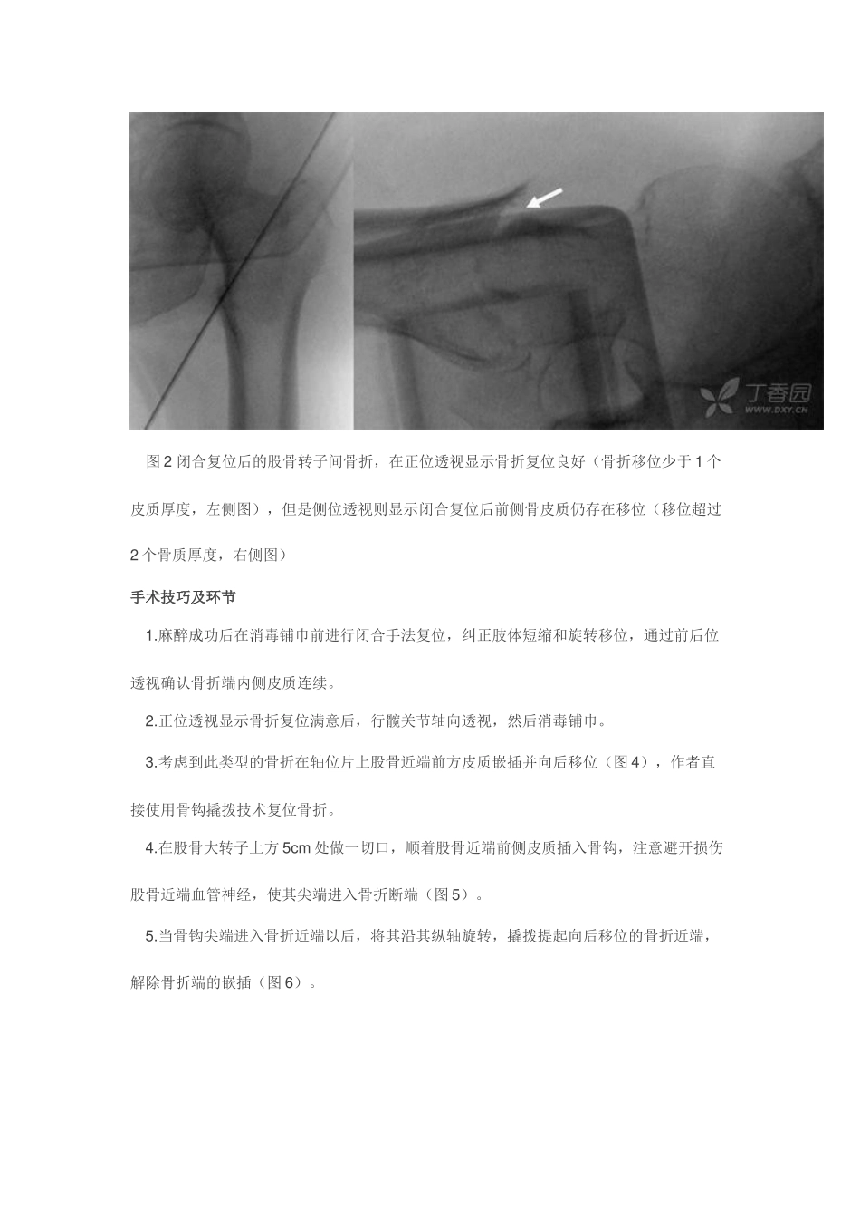 股骨转子间骨折骨钩撬拨复位技术_第3页
