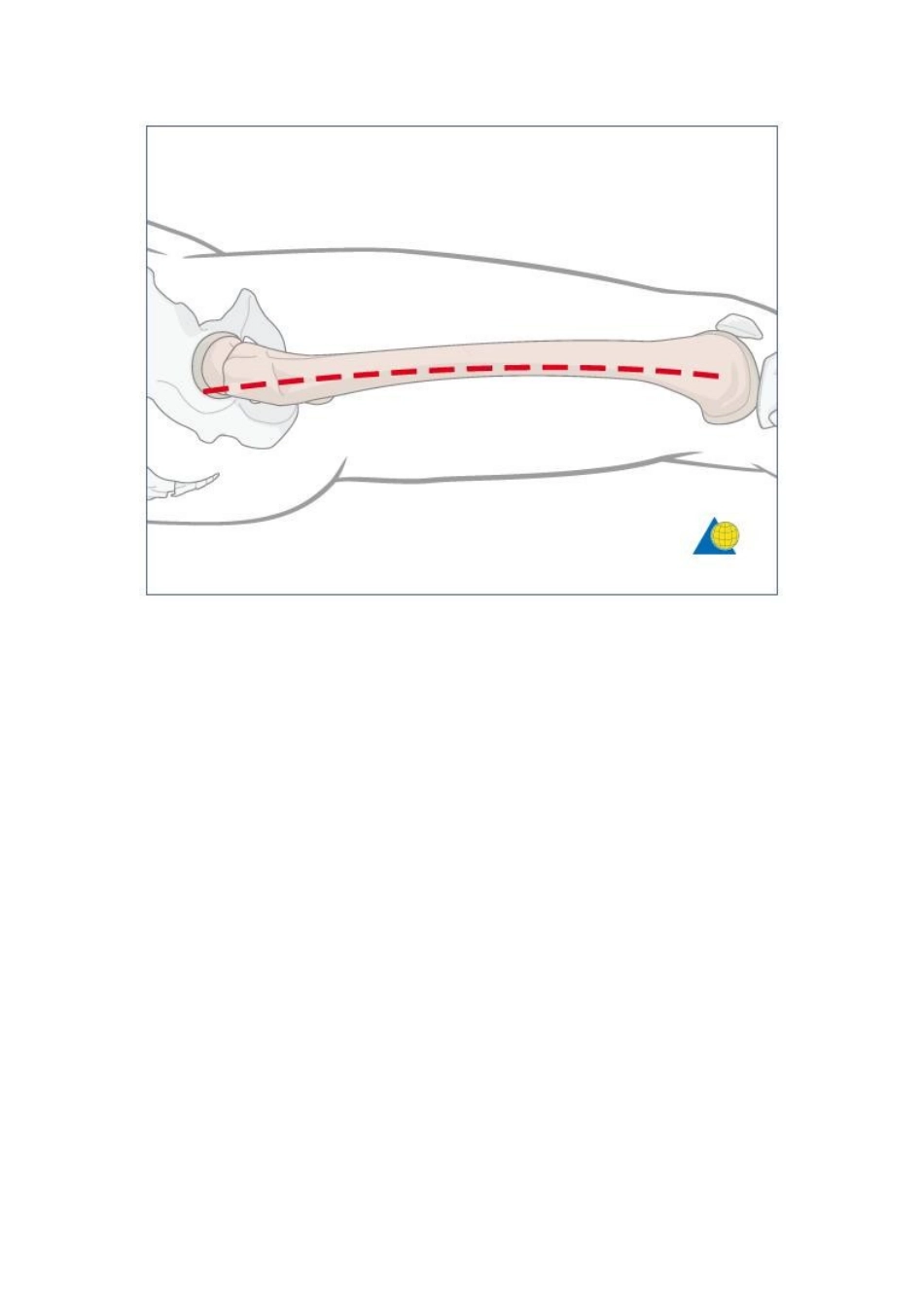 股骨干外侧入路_第2页