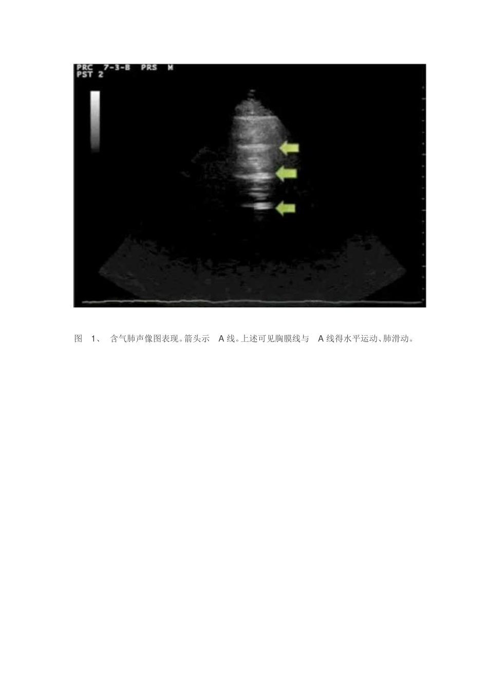 肺部超声检查_第2页