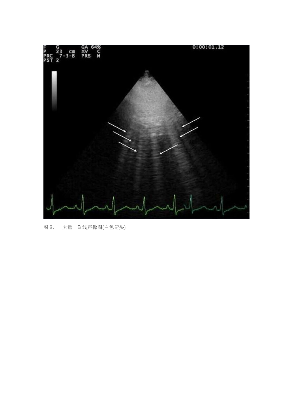 肺部超声检查_第3页