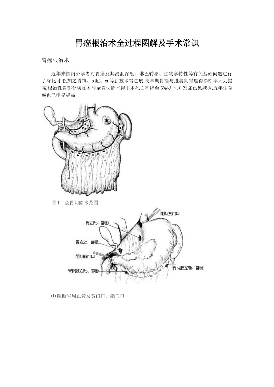 胃癌根治术全过程图解及手术常识1_第1页