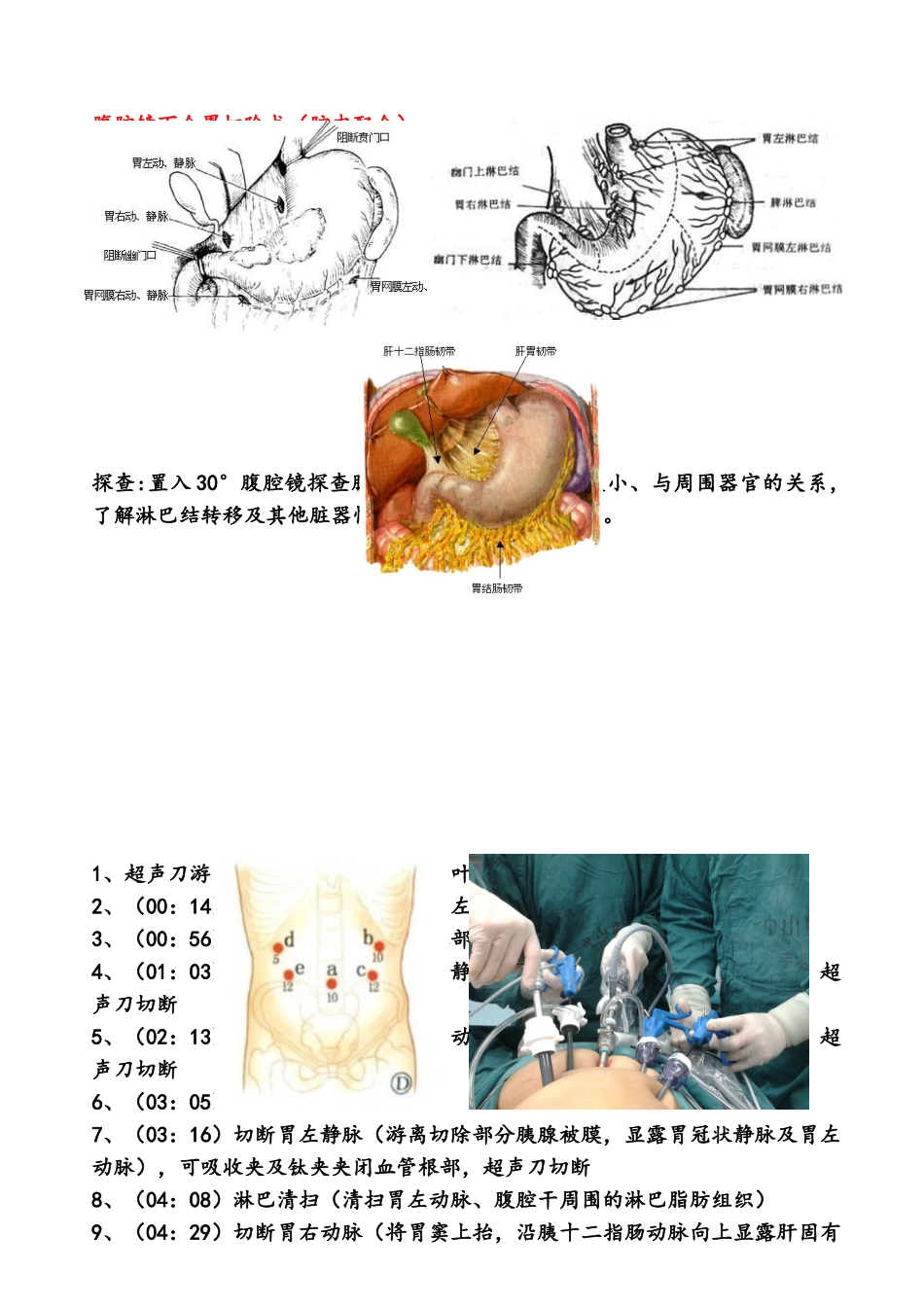 腔镜下全胃切除术手术步骤_第2页