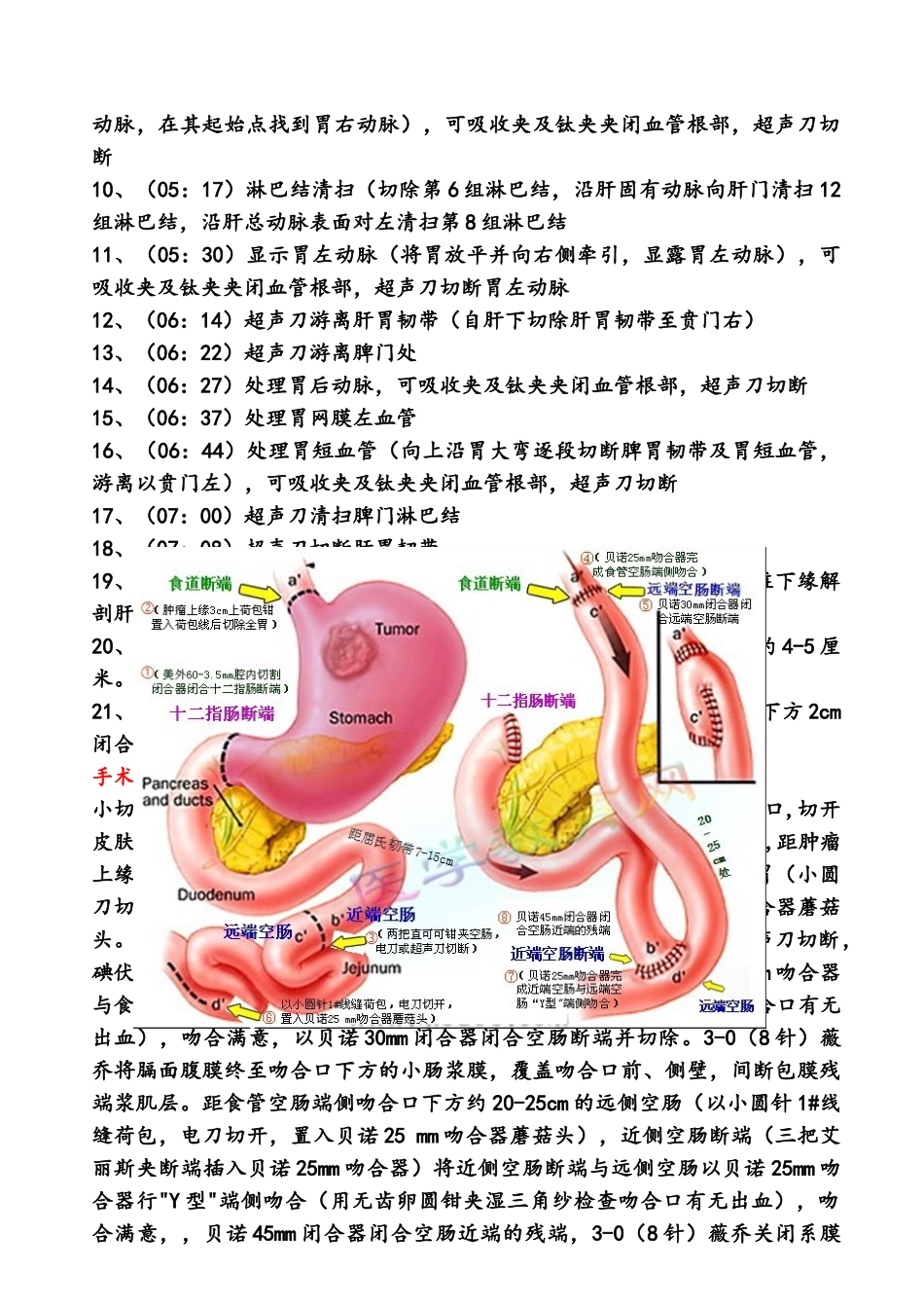 腔镜下全胃切除术手术步骤_第3页