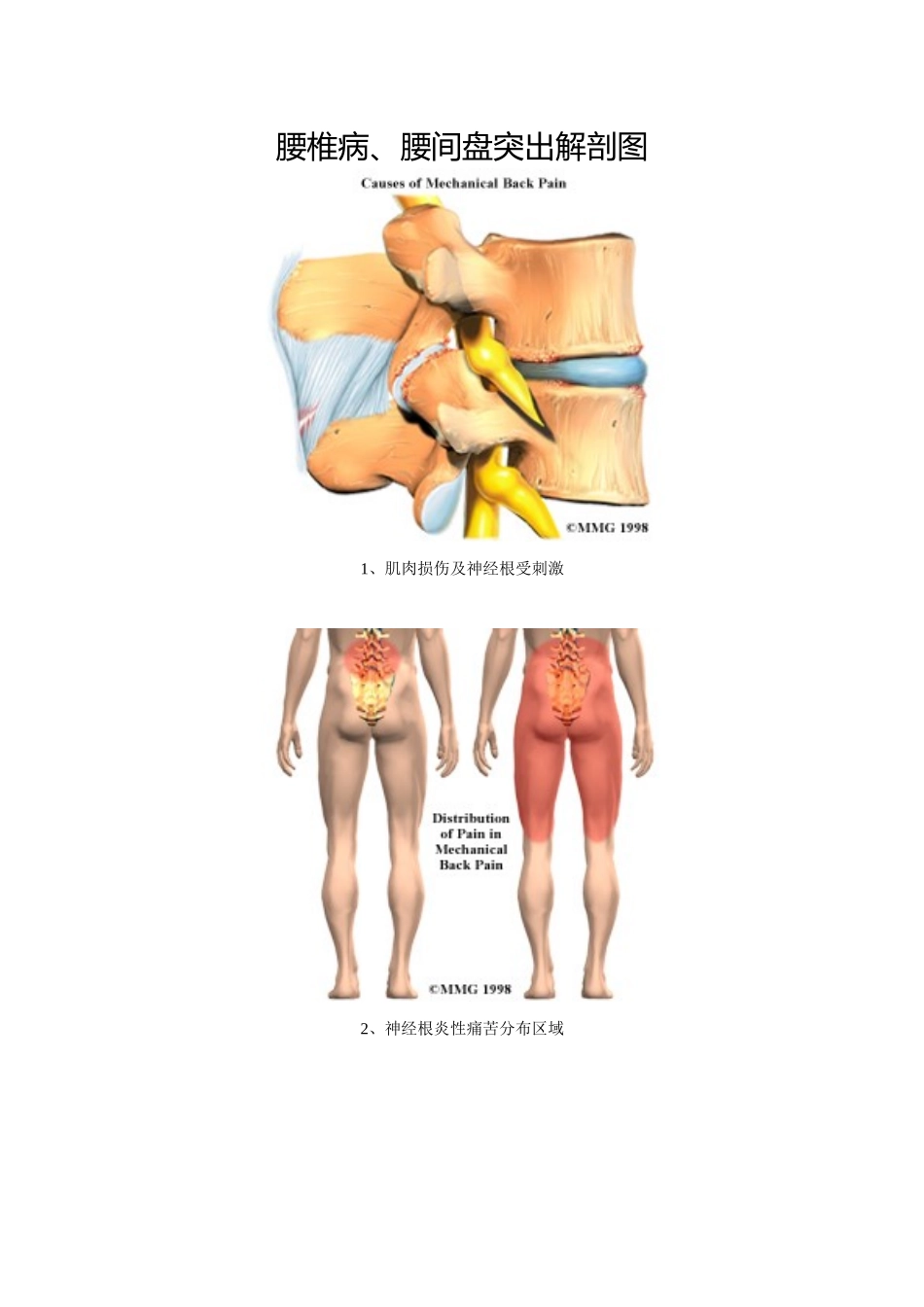 腰椎病、腰间盘突出解剖图_第1页