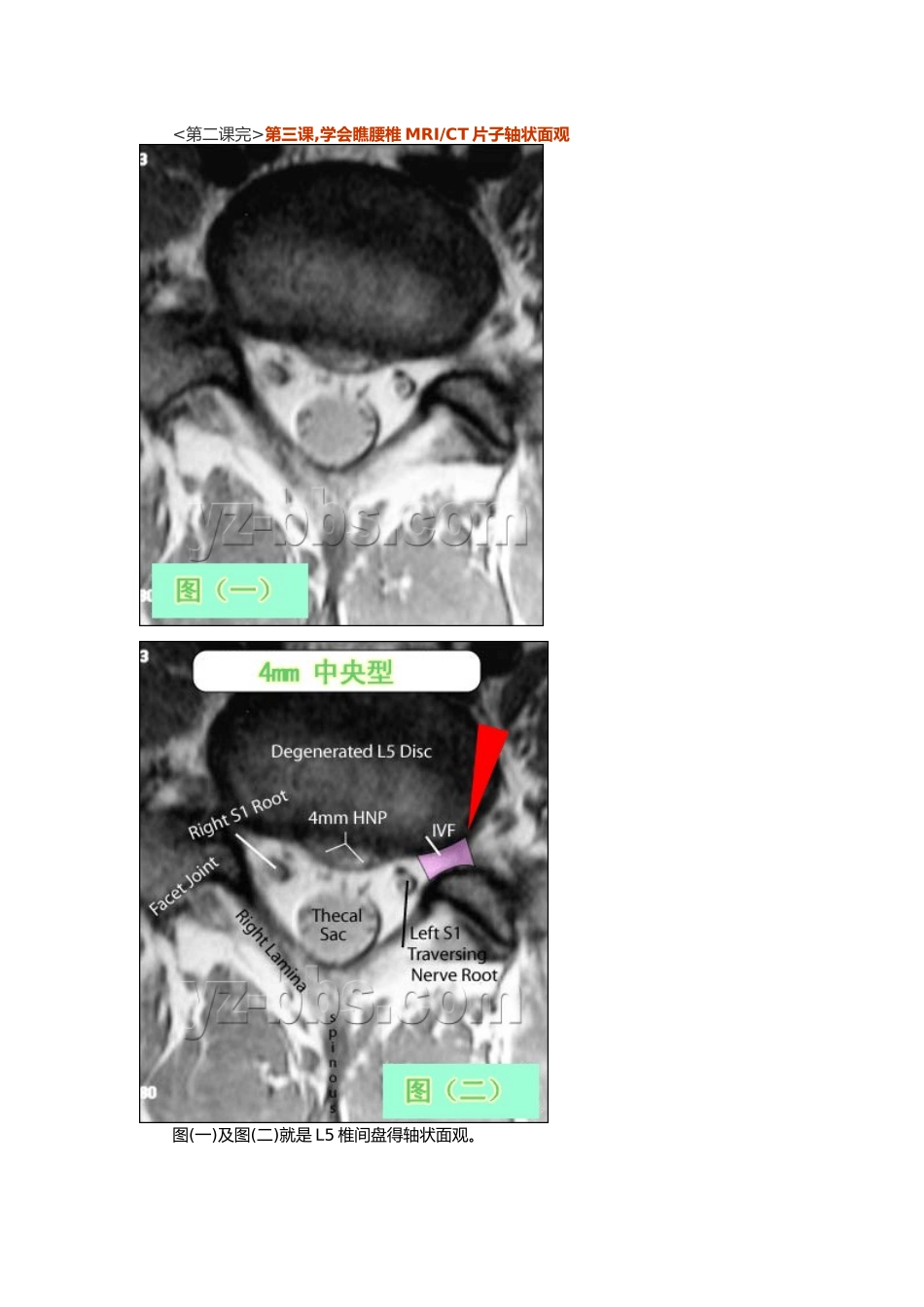 腰椎MR,一瞧就会_第3页